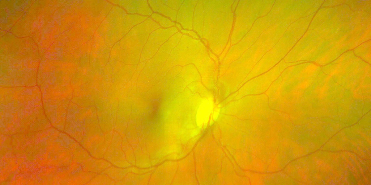 Stem cell-based retinal implant tested for common cause of vision loss