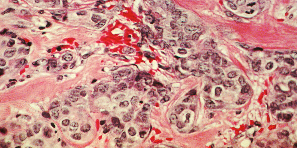 Breast cancer cells. Image/Wikimedia Commons