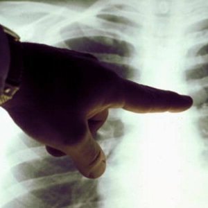 A photo of a person pointing at lungs in an x-ray