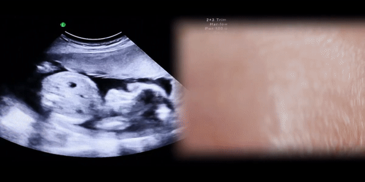 Ultrasound Gave Us Our First Baby Pictures. Can It Also Help the Blind See?