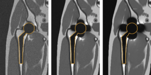 Simulated imaging of a total hip replacement using (left to right) 0.55 Tesla, 1.5 Tesla, and 3 Tesla MRI. Notice the reduced distortions at lower field strengths. (Photo Credit: Kübra Keskin)