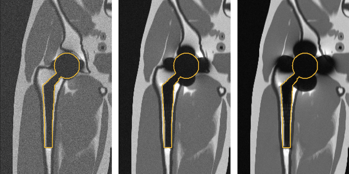 Simulated imaging of a total hip replacement using (left to right) 0.55 Tesla, 1.5 Tesla, and 3 Tesla MRI. Notice the reduced distortions at lower field strengths. (Photo Credit: Kübra Keskin)