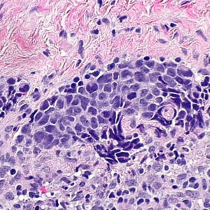 Small Cell Carcinoma in a lymph node. Image/Wikimedia Commons