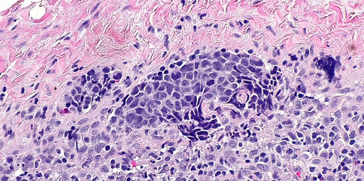 Cancer cells in a lymph node.