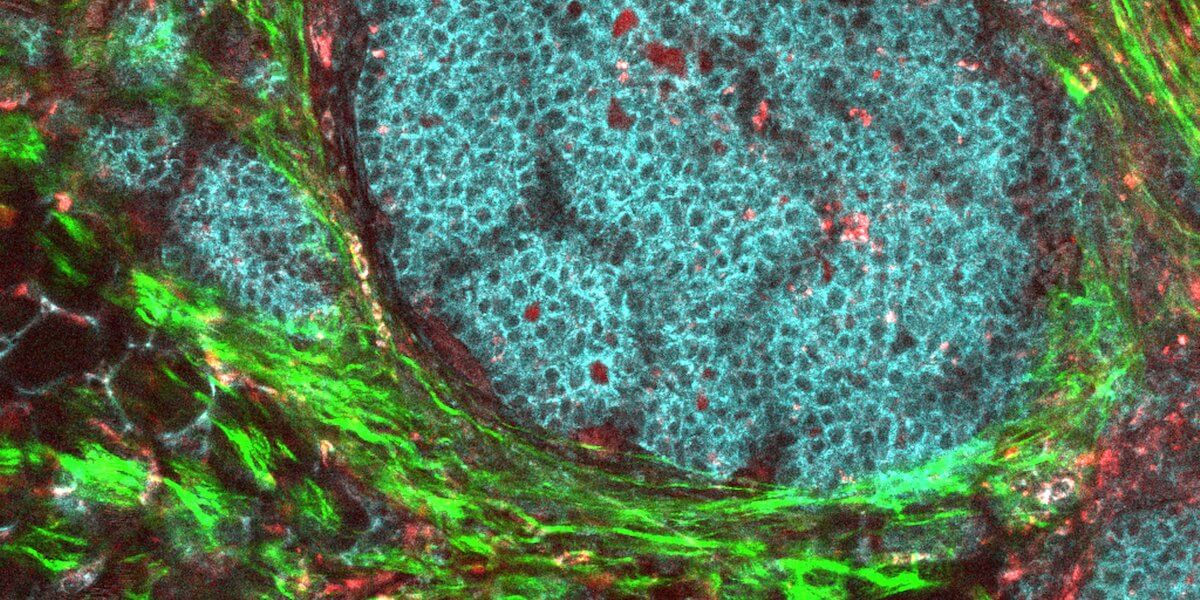 A breast cancer tumor and its surrounding microenvironment. Image/National Institutes of Health