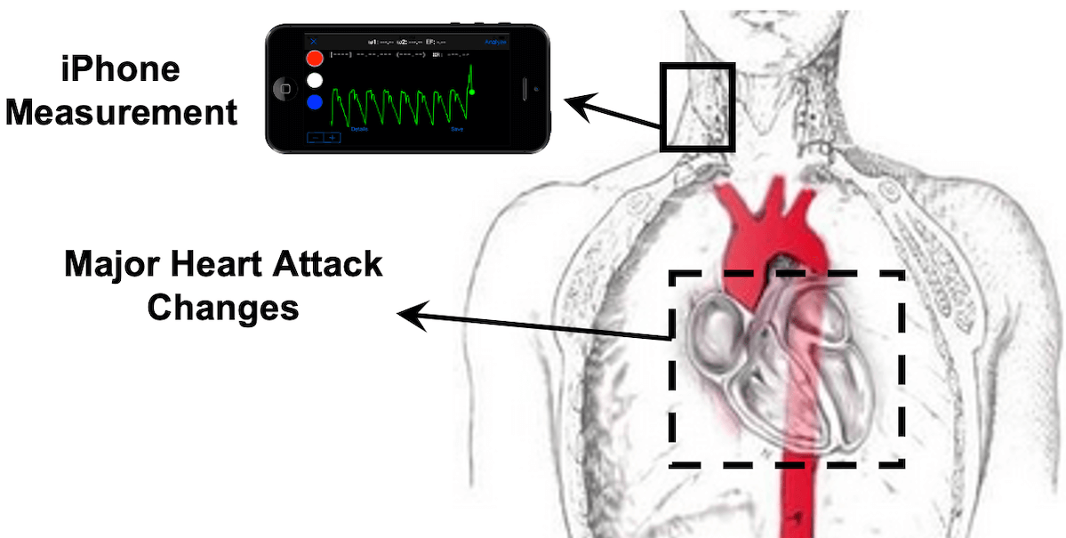 Device designed at USC aims to provide warnings of super-silent heart attacks
