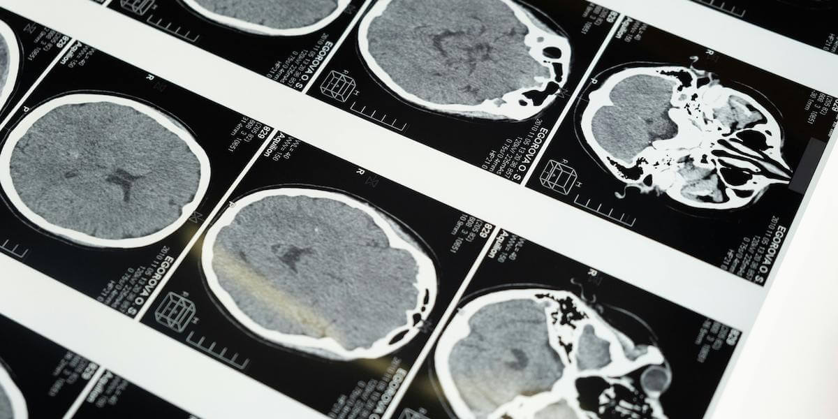 MRI images of the brain. Photo/Pexels