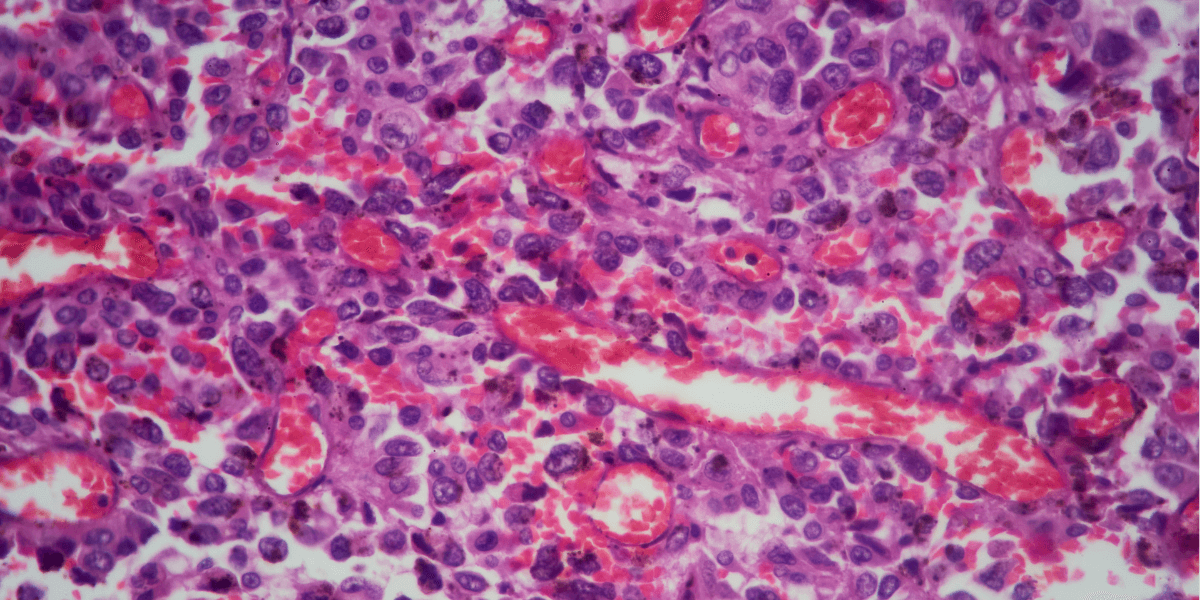 Using advanced computational methods, the researchers discovered 95 genes significantly associated with survival in cancers such as breast, ovarian, skin, and gastrointestinal cancers. Pictured: lung tissue adenocarcinoma as seen under a microscope. Photo/iStock.