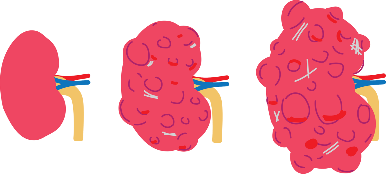 In autosomal dominant polycystic kidney disease (ADPKD), cysts form on the kidneys (far right) Image/Wikimedia Commons.